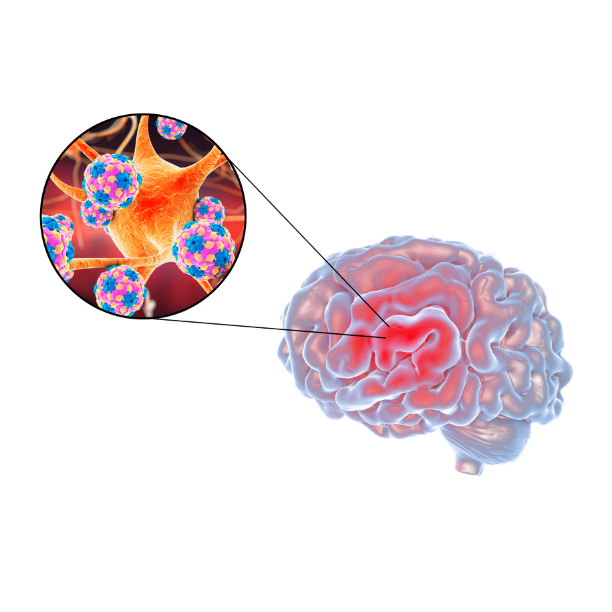 Encephalitis Stem Cell Treatment