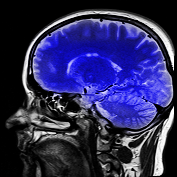 Epilepsy Stem Cell Treatment